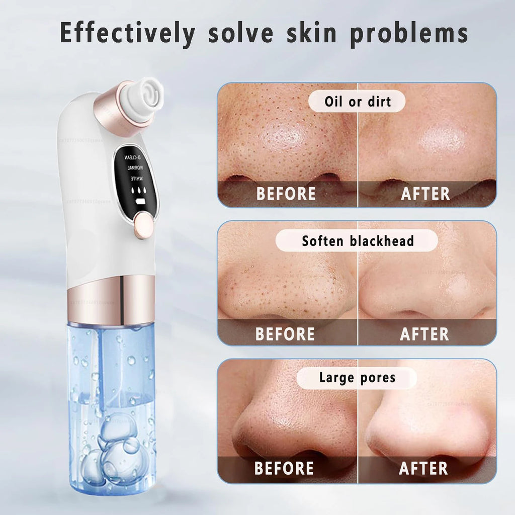 Blackhead remover vacuum displaying before and after pore cleansing results